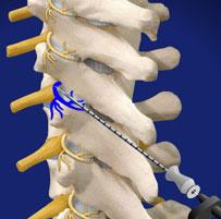 Injection of medial branch nerve to facet joint
